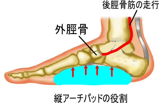 有痛性外頸骨　大原接骨院　足底板